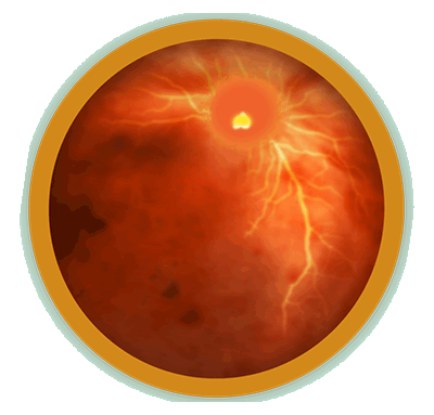 Age-Related Macular Degeneration Education